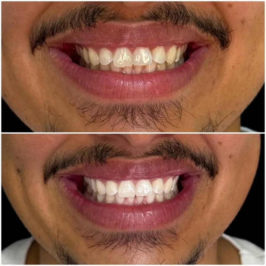Estética Dental