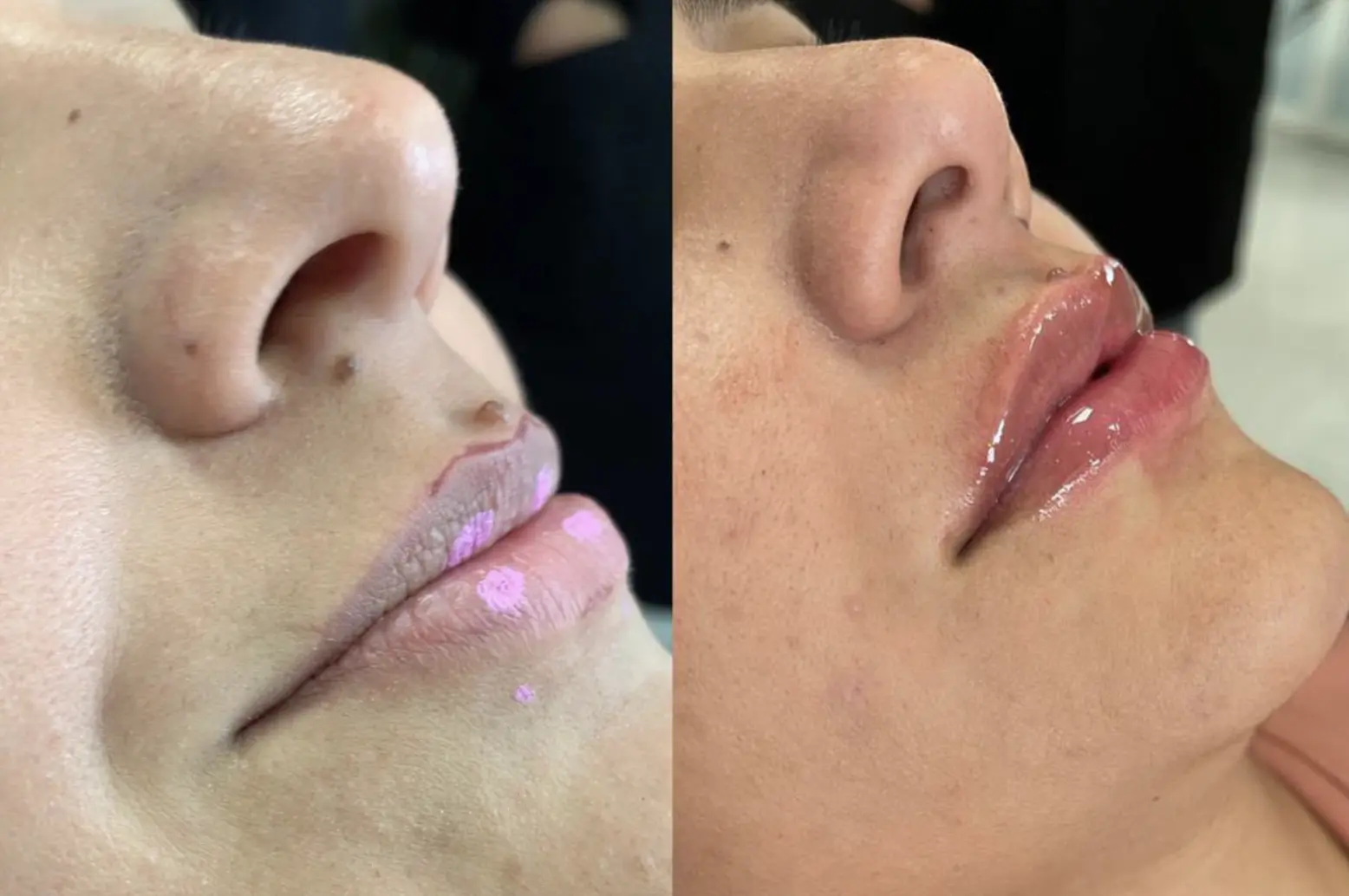 Harmonização Facial